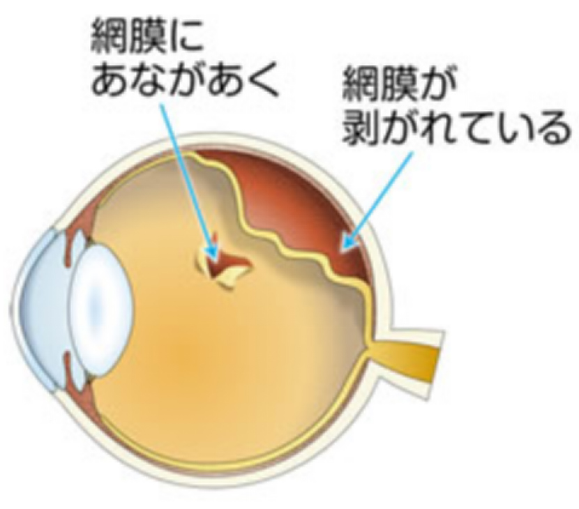 裂孔原性網膜剥離の眼